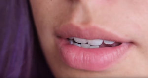 Полное обновление улыбки - нижний зубной ряд